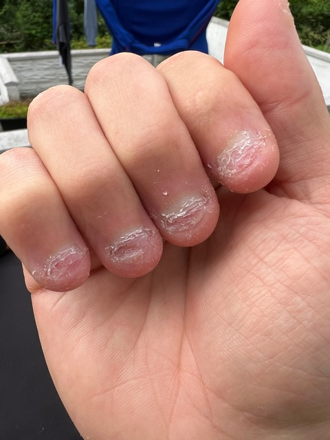Header of bittennails